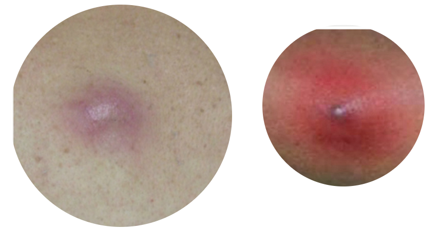 3.皮脂腺囊肿保持良好的心态.