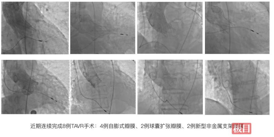 83 岁李奶奶心脏重度狭窄，微创换瓣重生