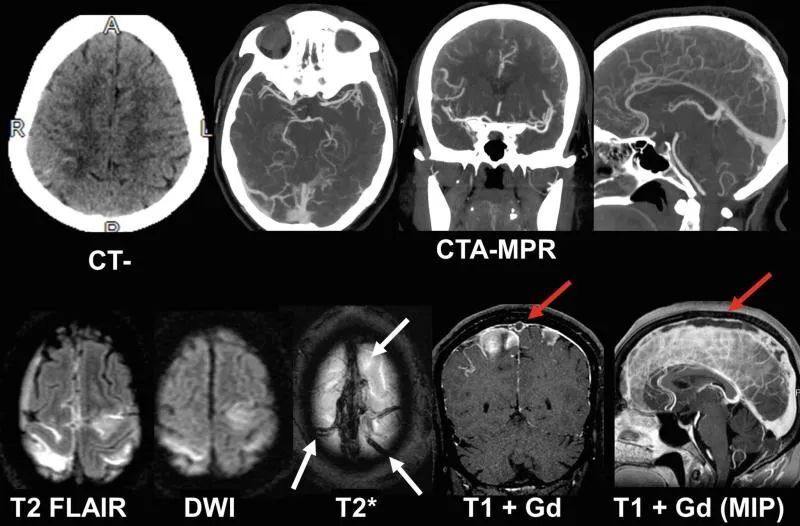 这6种疾病可能被误诊为脑卒中,你都清楚吗?丨临床必备