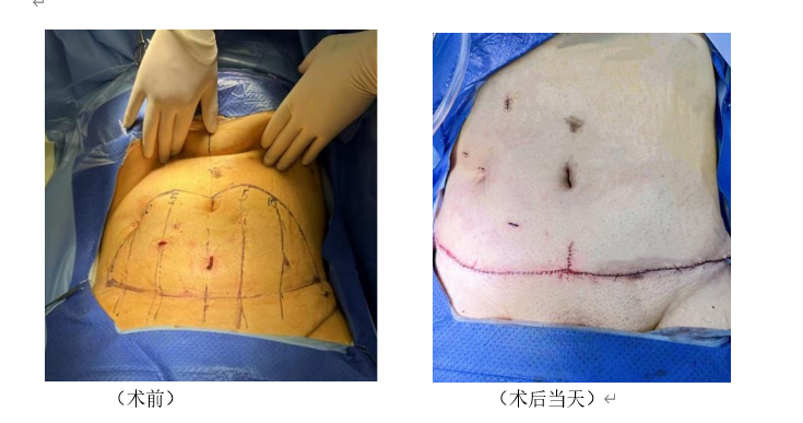男子手术减重80斤腹部皮肤垂到大腿,接受腹壁整形手术