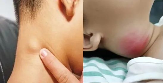 目前认为感染所致的淋巴结反应性增生为淋巴结肿大的最常见病因,常见