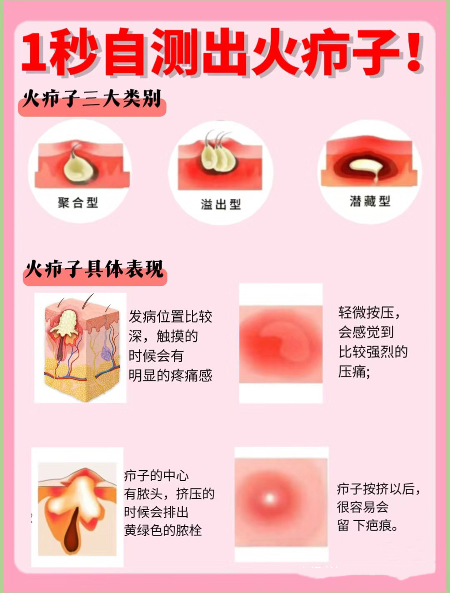 痘痘千万别乱挤小心小疖变大劫