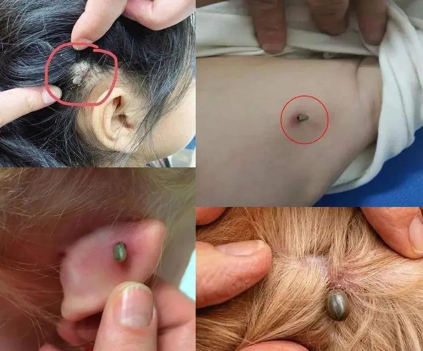 从发病到死亡仅7天!春夏外出,千万警惕这种"夺命虫"