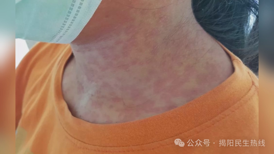 猩红热是由a族β型溶血性链球菌感染引起的急性呼吸道传染病,可引起