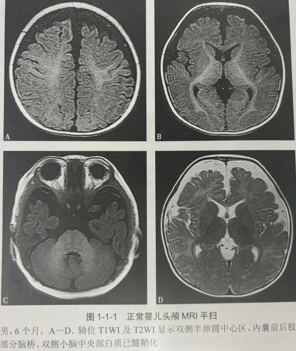 婴幼儿颅脑发育及影像学表现