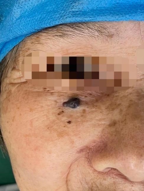 杭州阿姨脸上莫名长痣 医院诊断:并没有这么简单_腾讯新闻
