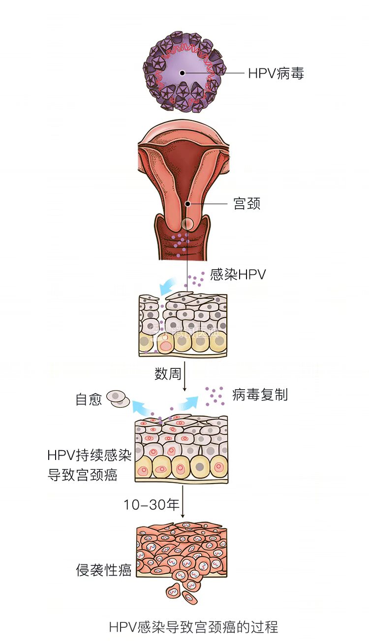 hpv症状妇科图片