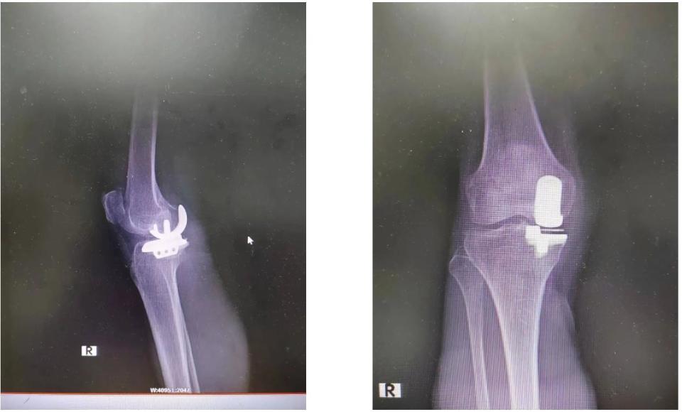 单髁置换让膝关节炎患者燃起新"膝"望
