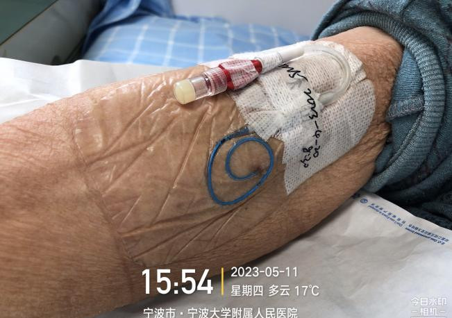 picc导管脱出长达8cm还能继续保留使用吗