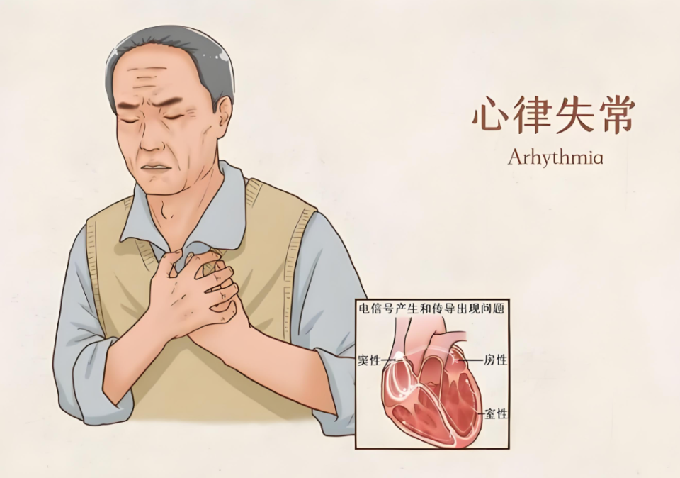 心房颤动是最常见的心律失常之一,它会导致心脏节律