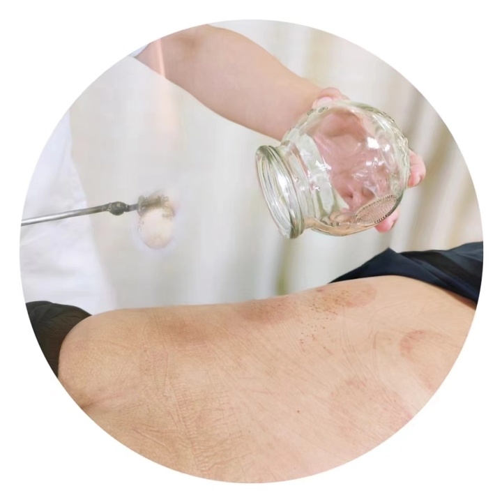 健康小站迎亚运 | 运动健儿们都热衷的拔罐疗法,家庭保健时该怎么用