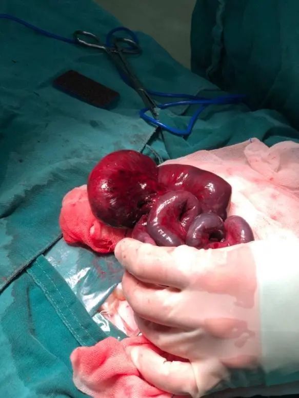 因胎动减少入院,宝宝刚出生就开腹切了一段肠子