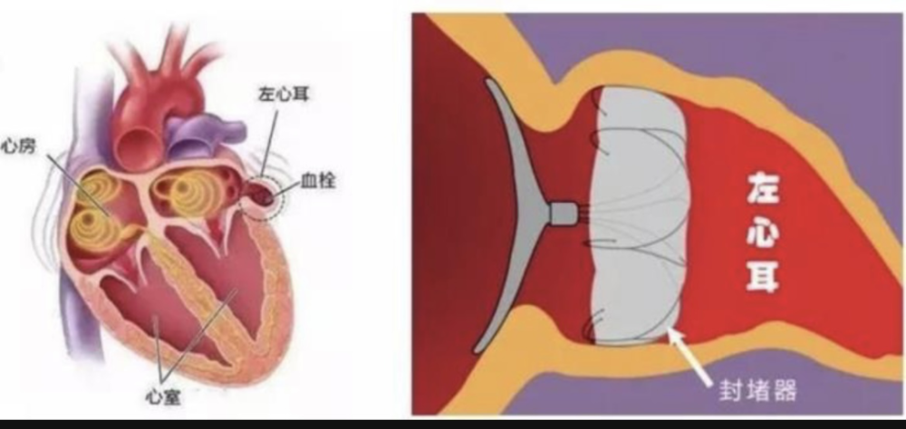 左心耳封堵手术无须开刀,仅需在股静脉穿刺一个针眼