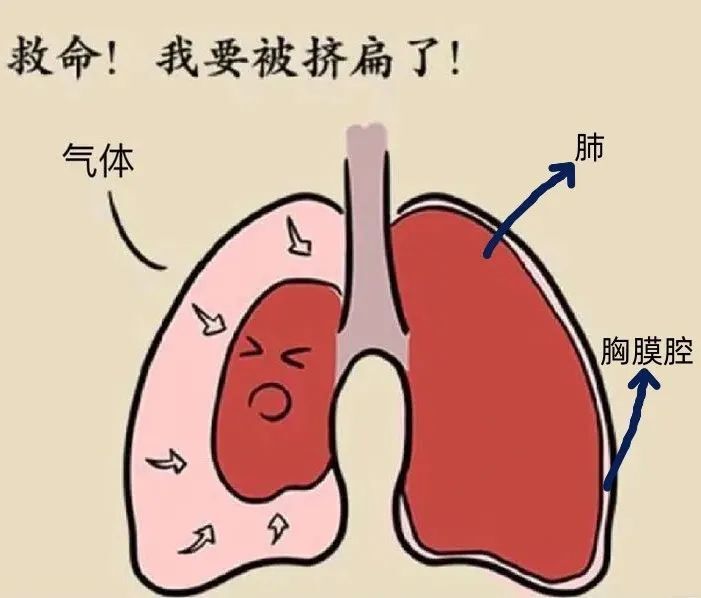 只要胸膜腔里有了气体,不管什么原因,医学上就称作气胸