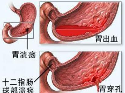 幽门螺旋杆菌什么症状啊（幽门螺杆菌6个症状）-图3