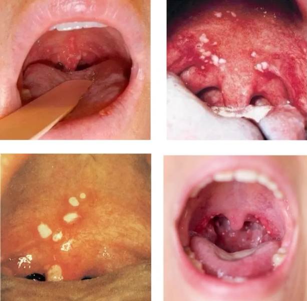 中招后喉咙"长泡泡",出现这些症状千万要注意