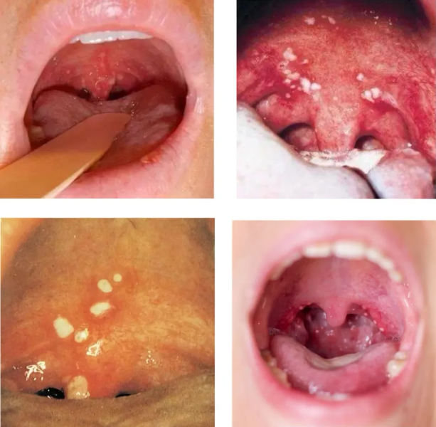 扁桃体发炎喉咙壁起泡图片