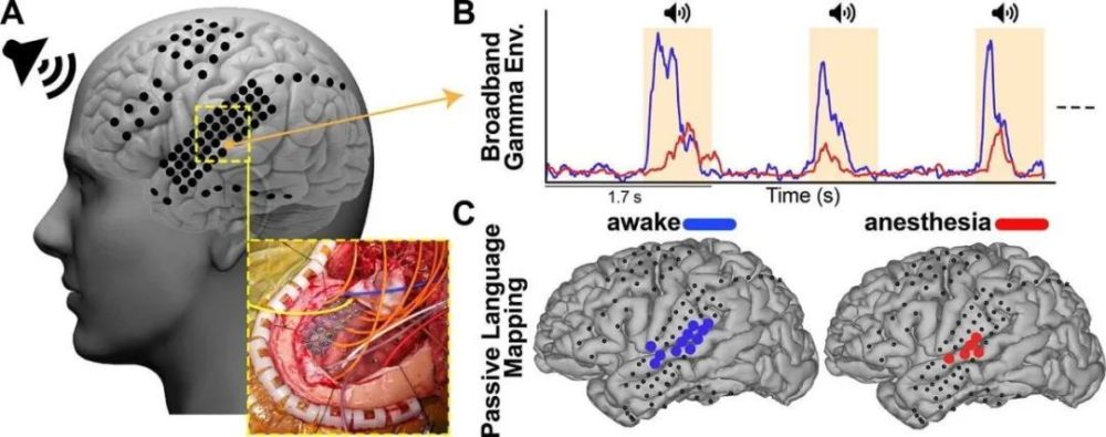 绘制脑功能图谱的ecog技术,有望变革清醒开颅手术?_腾讯新闻