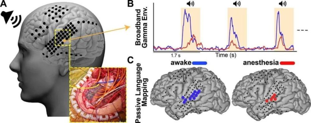 繪製腦功能圖譜的ecog技術,有望變革清醒開顱手術?_騰訊新聞
