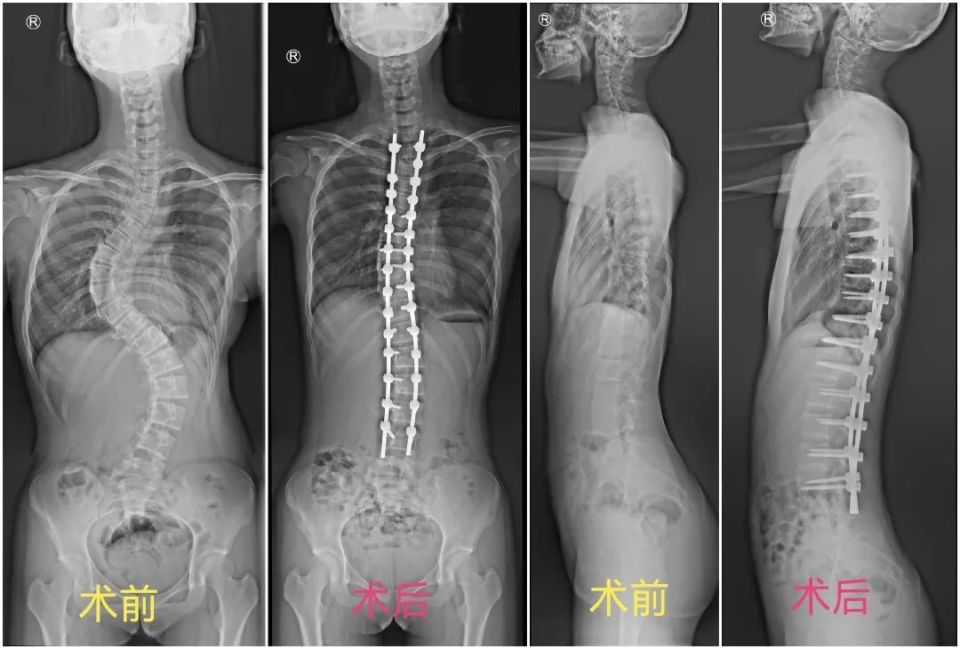 着急万分的家属多方打探,得知莆田学院附属医院在治疗脊柱侧弯畸形