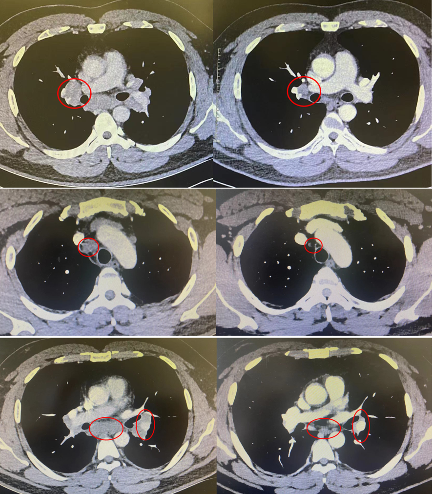 治疗刚陷「两难抉择」又起脑膜占位风波?何处觅真凶?
