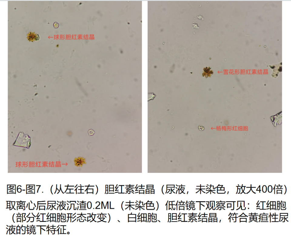 胆红素结晶图片图片