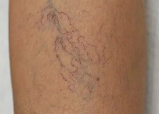 苏磊医生答疑:腿上青红血丝是否为静脉曲张?解析成因与健康风险_腾讯