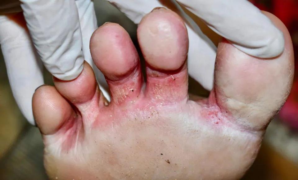 脚趾间发白糜烂,瘙痒难耐?警惕是脚气!