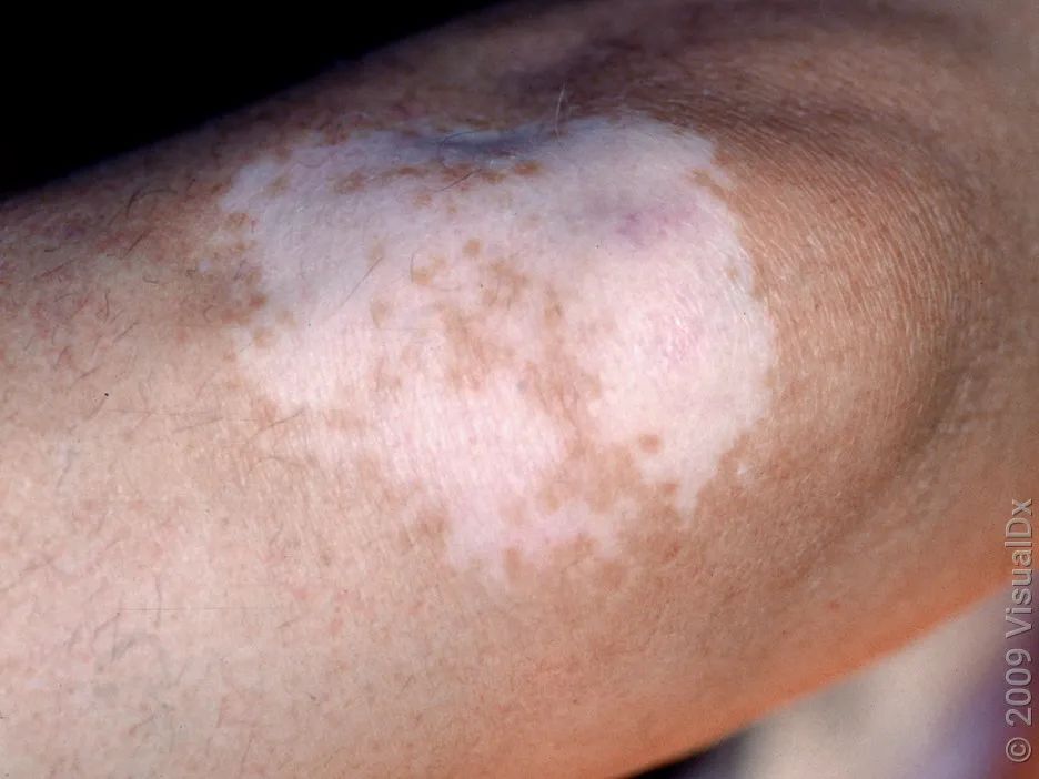 一到夏天身上长这种白斑,其实是真菌感染!