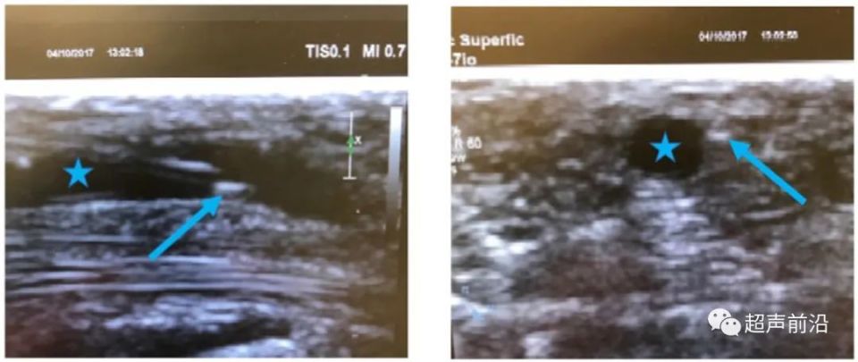 ge医疗器械怎么样GE vs 飞利浦 vs Butterfly ： 手持超声参数差异对比_https://www.jmylbn.com_新闻资讯_第3张