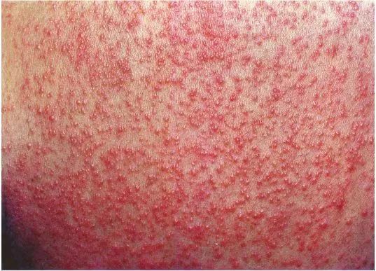 痱子又分为白痱,红痱,脓痱:除此之外,破坏表皮的皮肤病,紫外线或电离