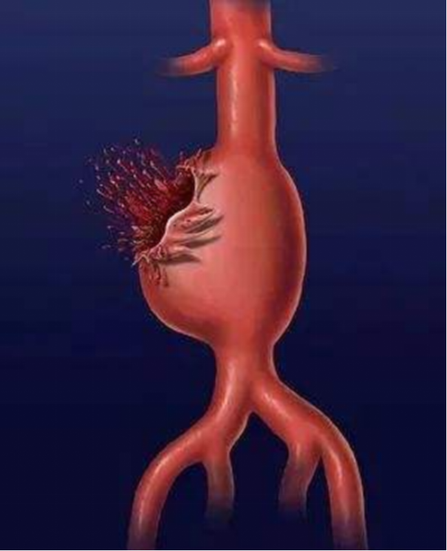 "血管炸弹"爆裂出了全身1/3的血,介入专家"拆弹"成功救治