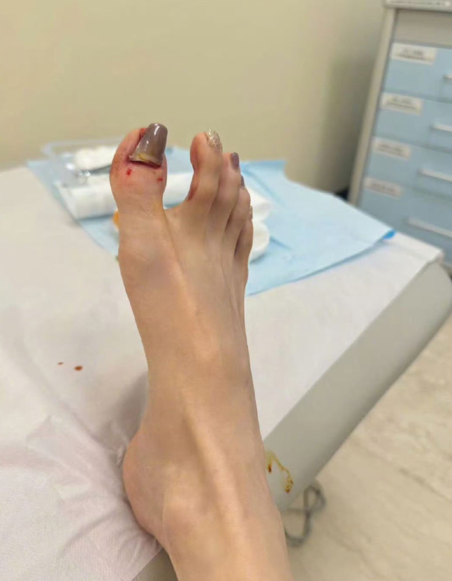她的大拇指应该是大量出血,因为都染到旁边的脚趾上了,而且脚趾盖被拔