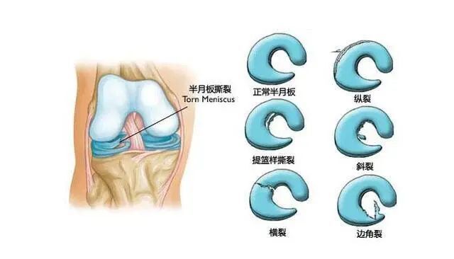 膝半月板位置图片图片