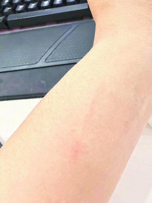 不小心被猫猫抓伤，要打狂犬疫苗吗？专家提醒_腾讯新闻