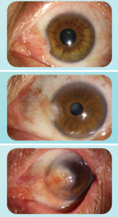 老人眼睛视物模糊,不一定是白内障,可能是这种眼病-腾讯新闻