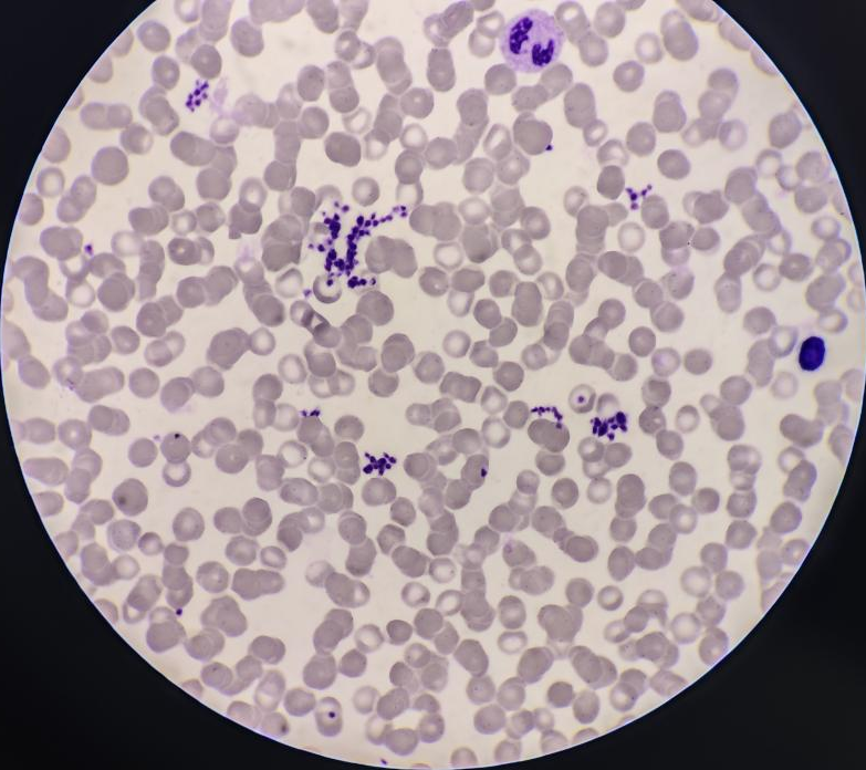 肿瘤患者血小板仪器计数减少未必是化疗造成的