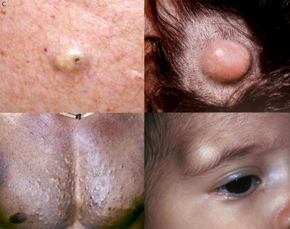 皮样囊肿(右下)为先天性的,常见于前囟,前额外侧眉毛处;多发性脂囊瘤