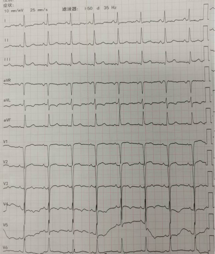 患者心电图为"窦性心律,v1-v3导联呈qs或rs型伴st段略抬高"(图1),难不
