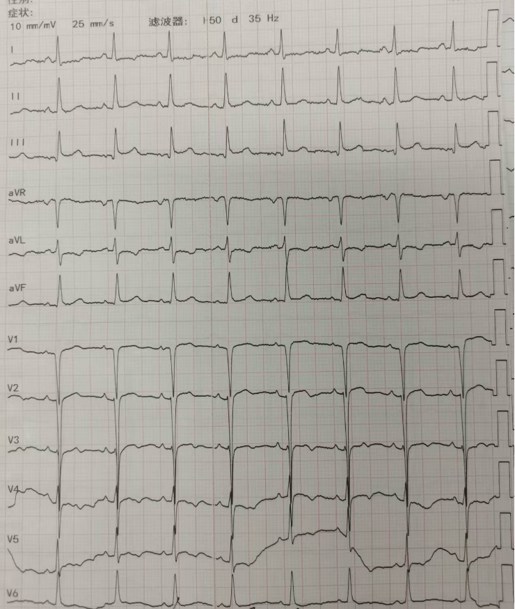 阿斯综合征心电图图片