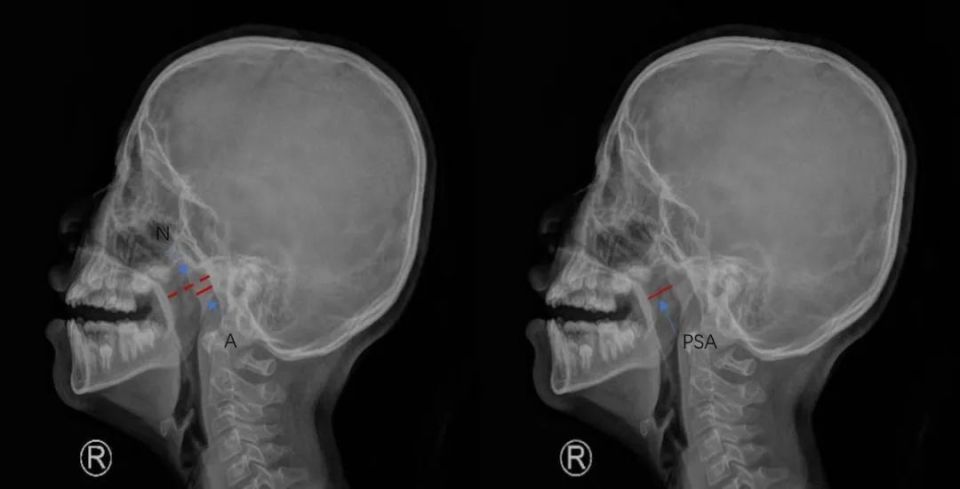 5mmct和mri也可以用于腺样体肥大的评估,ct和mri能够多方位显示腺样体