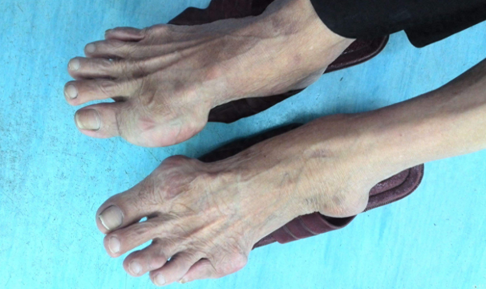 只因管不住嘴,14岁男孩患上痛风3年