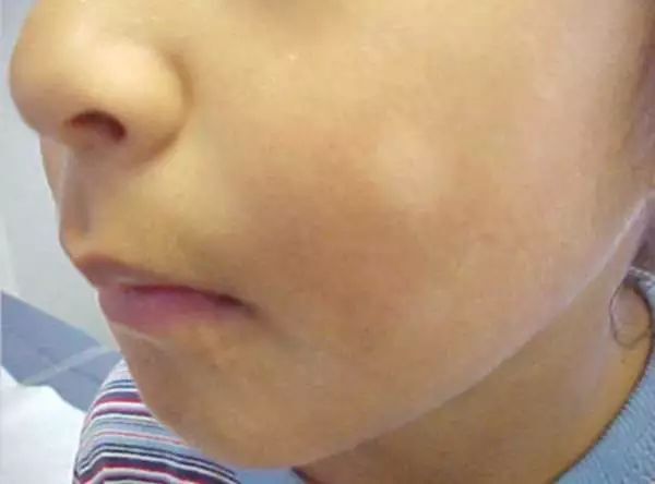 孩子脸上有白斑,需要吃打虫药吗?