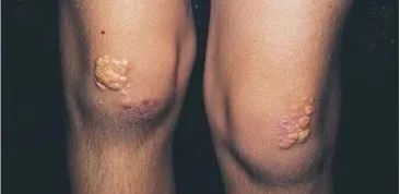 EV是什么针第一批90后已经高血脂！打一针管半年的降脂新方法来啦_https://www.jmylbn.com_新闻资讯_第4张