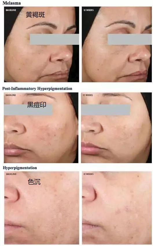 而且除了变黑,万恶的紫外线还会令我们的脸蛋出现肤色暗沉不均,皱纹