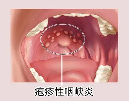 根据广东疾控发布的健康提示,疱疹性咽峡炎以急性发热,可持续高热或