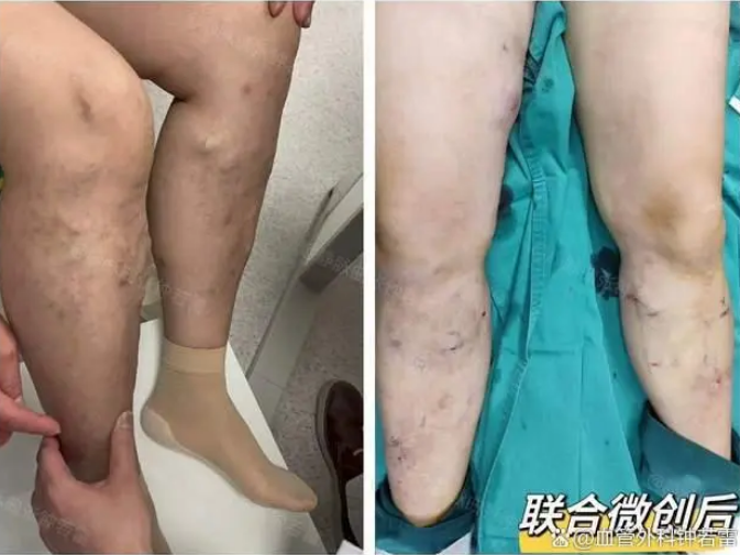 有治疗静脉曲张最好的方法吗?你关心的问题都在这!_腾讯新闻