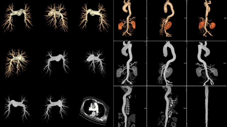 可完成极限心率冠脉清晰成像,黄陂区人民医院引进高端ct