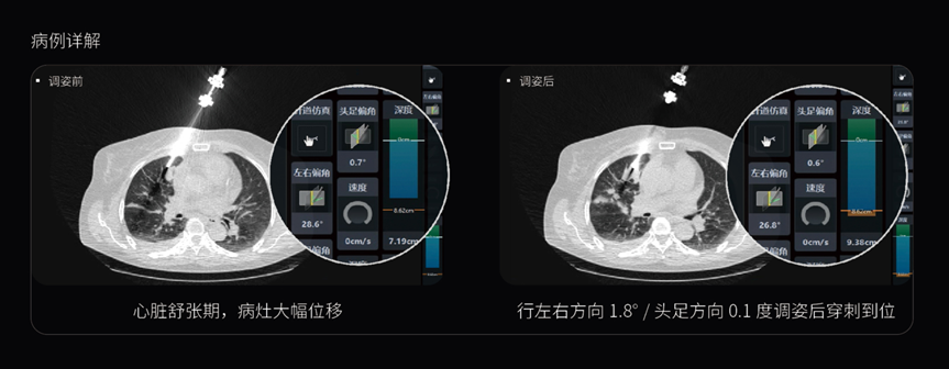 什么是联影ctCT引导介入手术边看边穿！联影集团又一全球首创_https://www.jmylbn.com_新闻资讯_第7张