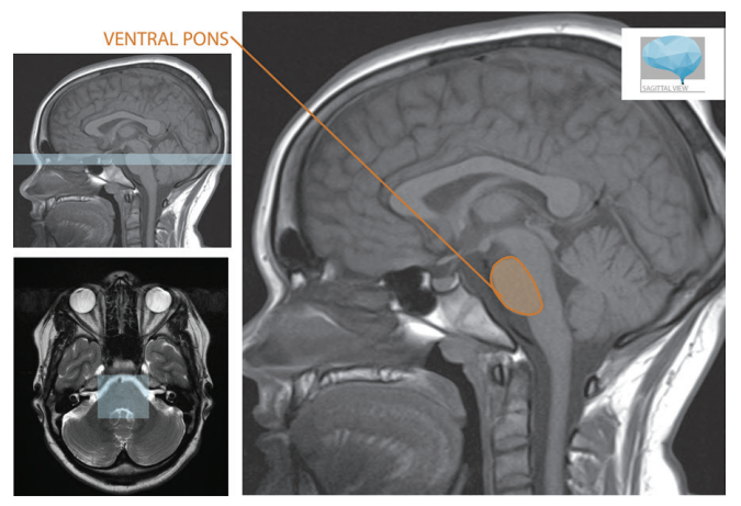 桥小脑角区解剖图MRI图片